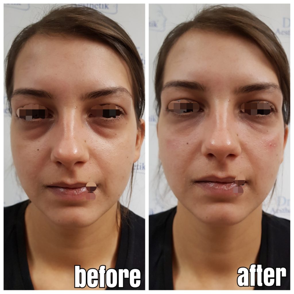 39+ Photodynamische therapie bilder vorher nachher , TraenenfurcheVorherNachher08 Dr. Aesthetik